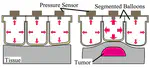 内視鏡手術における腫瘍探査を目的としたバルーン感圧式スコープの開発